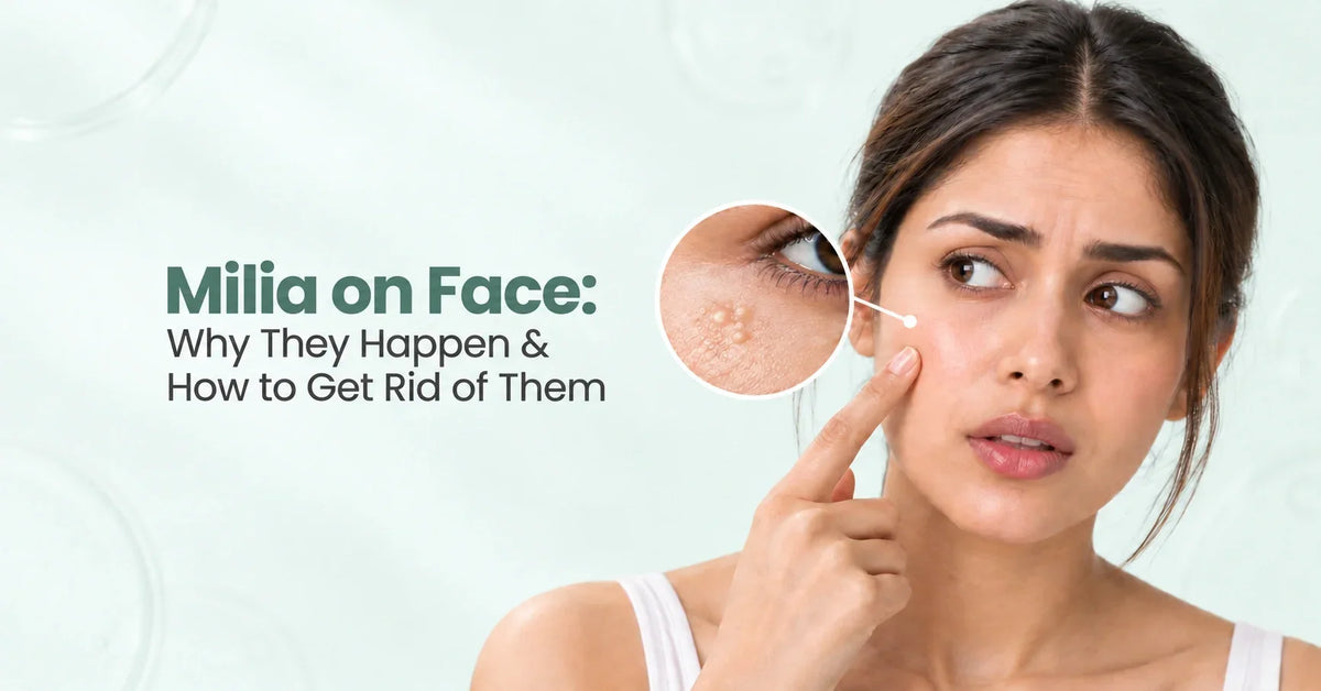 Milia on face shown on an Indian woman, with a magnified close-up of tiny white under-eye bumps and natural skin texture.