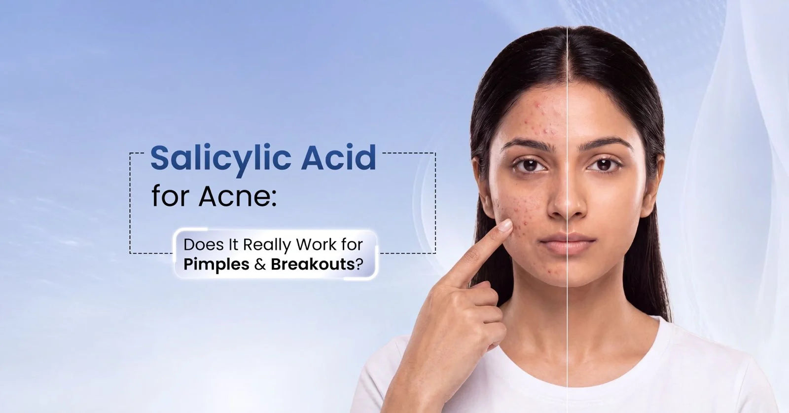 Salicylic acid for acne guide explaining how it works to treat pimples, unclog pores, reduce breakouts, and improve acne-prone skin.