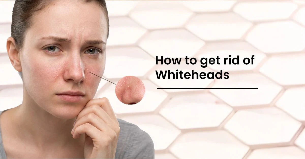 Effective methods to safely remove and how to get rid of whiteheads on nose and face without harming your skin.