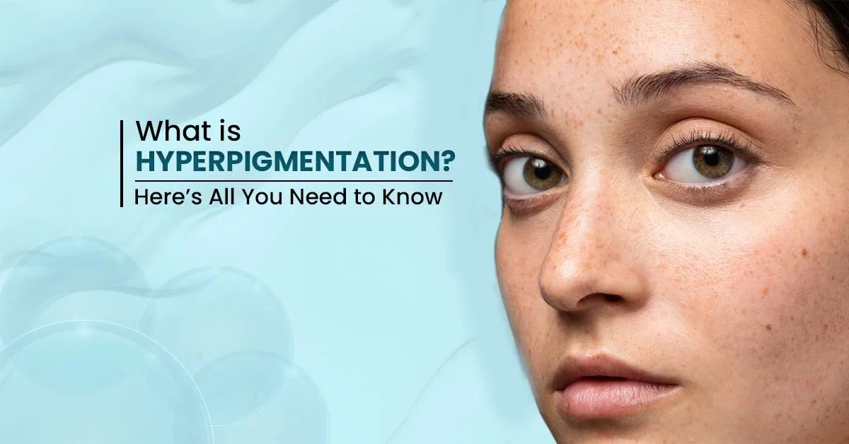 What is hyperpigmentation on face explained with causes, types, and treatment options