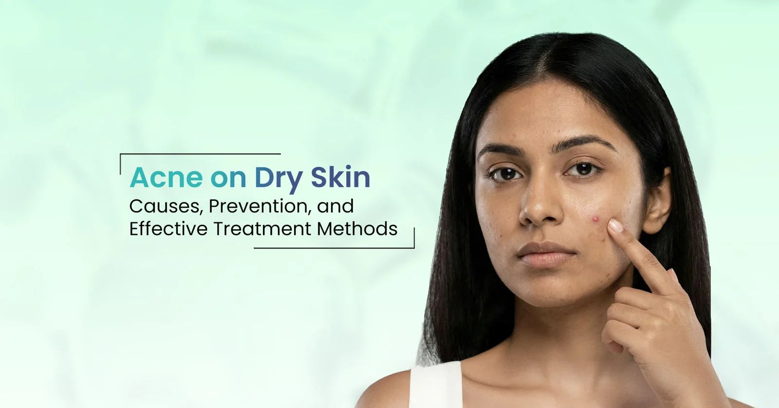 Acne on dry skin causes and treatment with skincare routine for dry acne-prone skin.