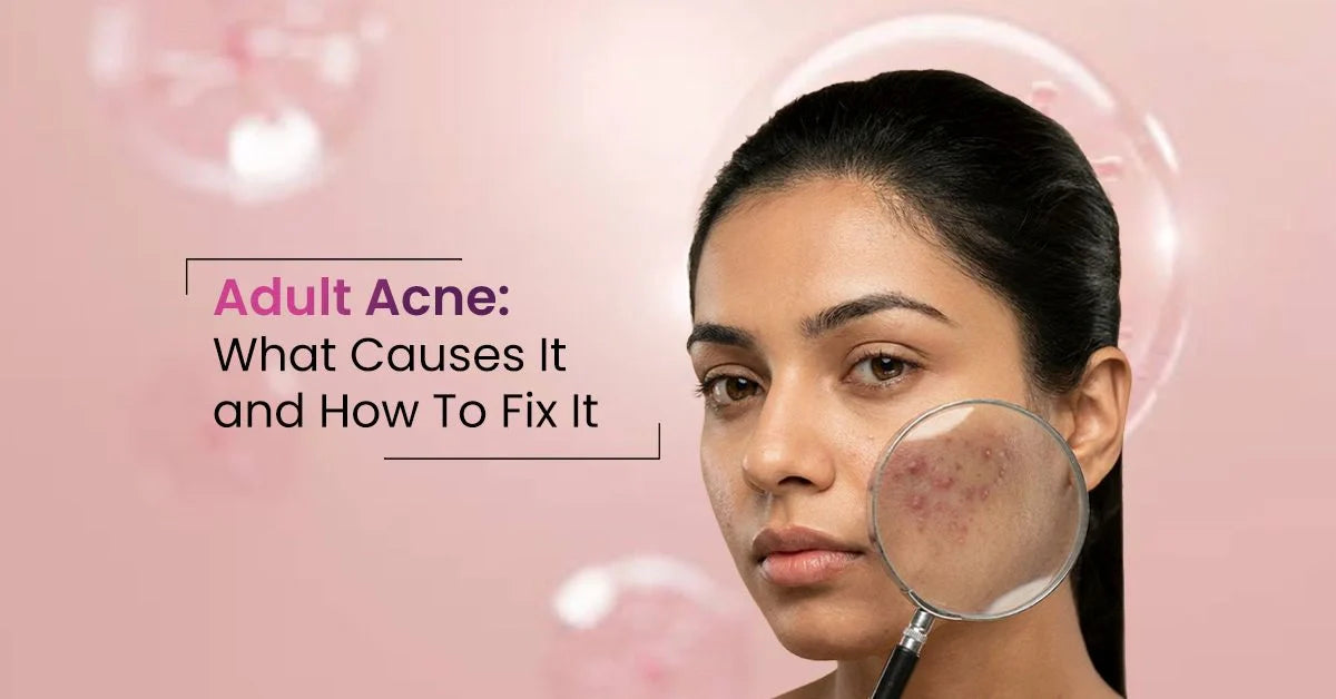 What causes adult acne and how to fix it with skincare solutions for hormonal breakouts
