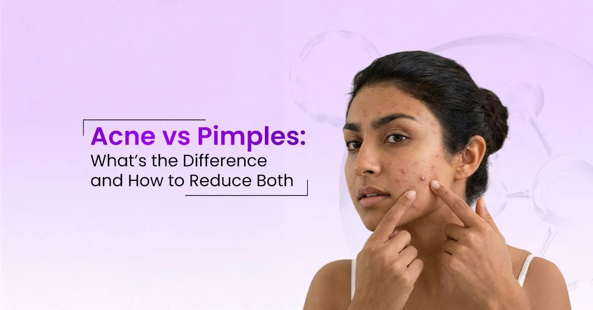 Difference between acne and pimples, including their causes, symptoms, and effective treatment to manage breakouts and improve skin health.