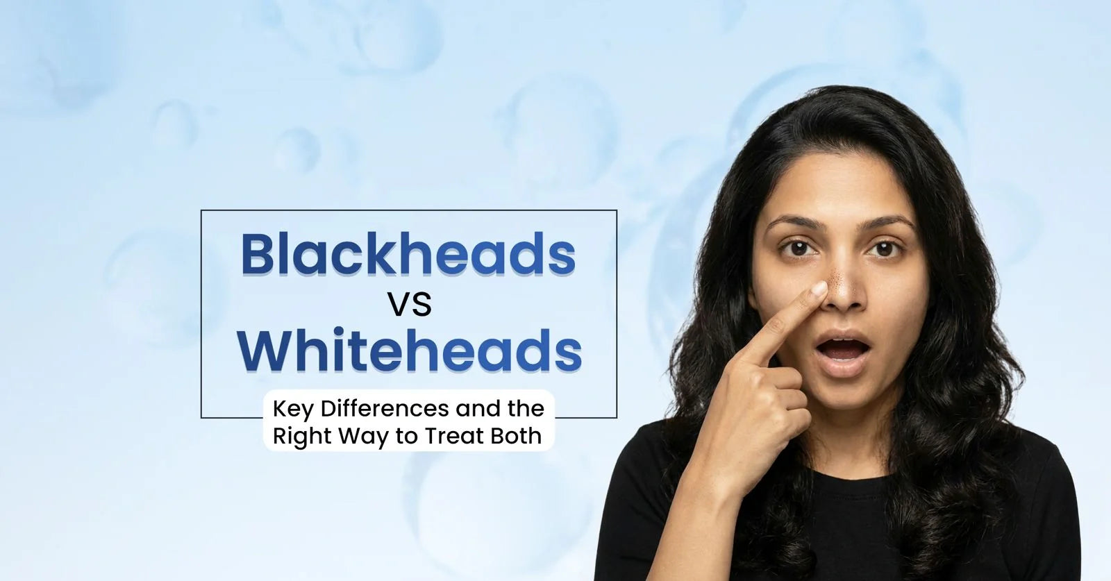 Woman comparing blackheads and whiteheads causes, symptoms, prevention tips, and effective skincare treatments.