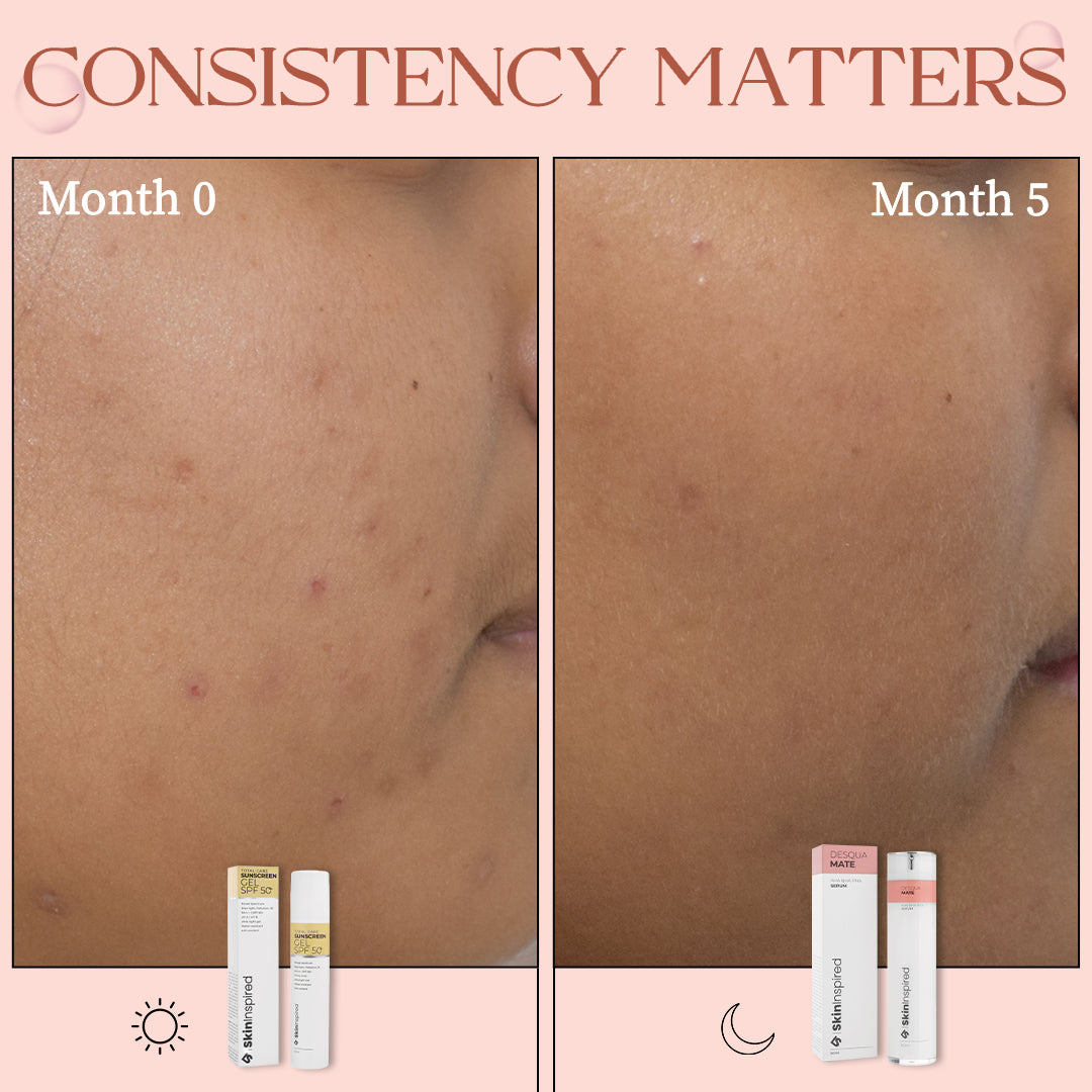 AHA BHA PHA Serum Improvement comparison