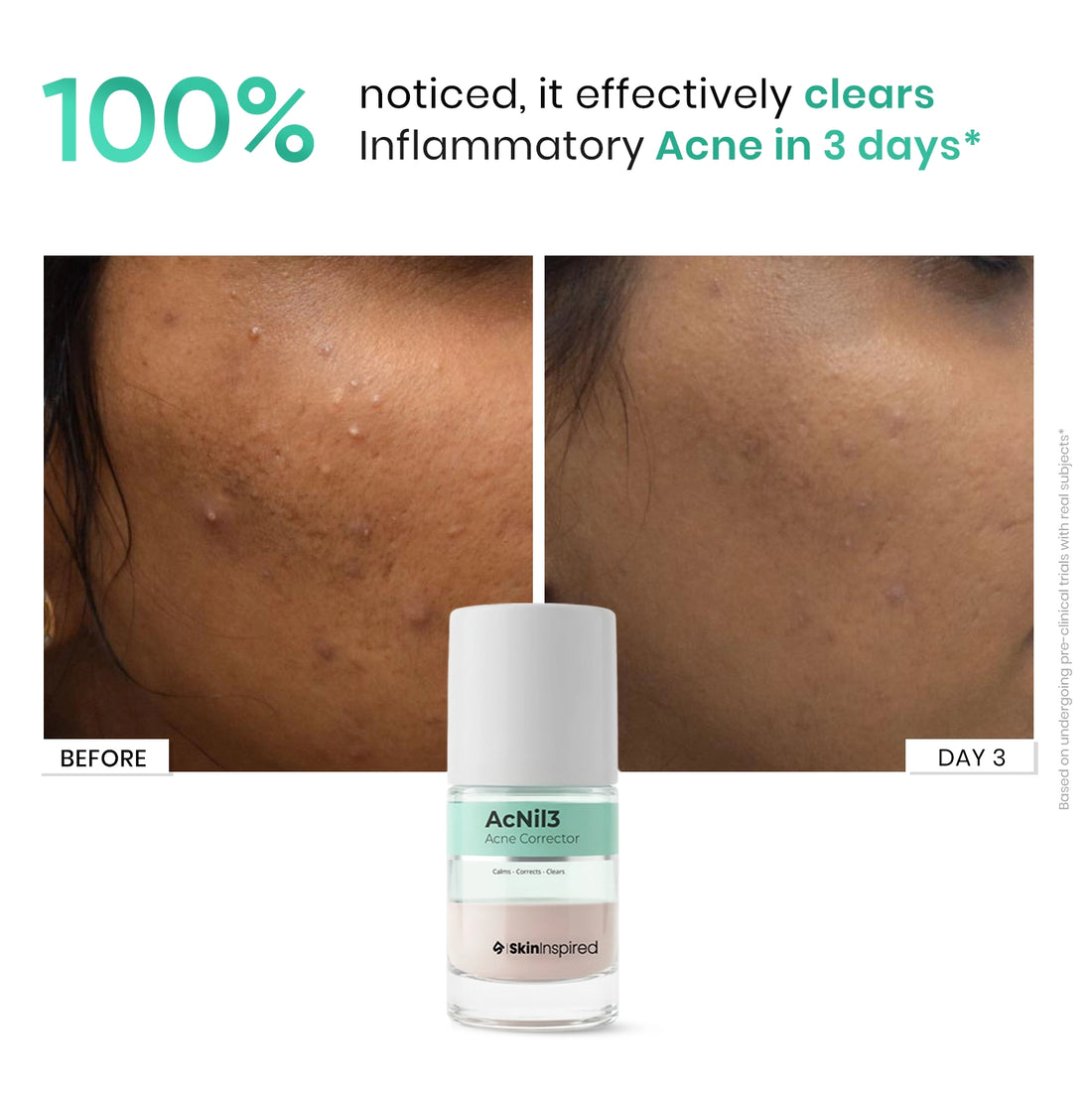 Acnil Acne Spot Corrector with Salicylic Acid Result