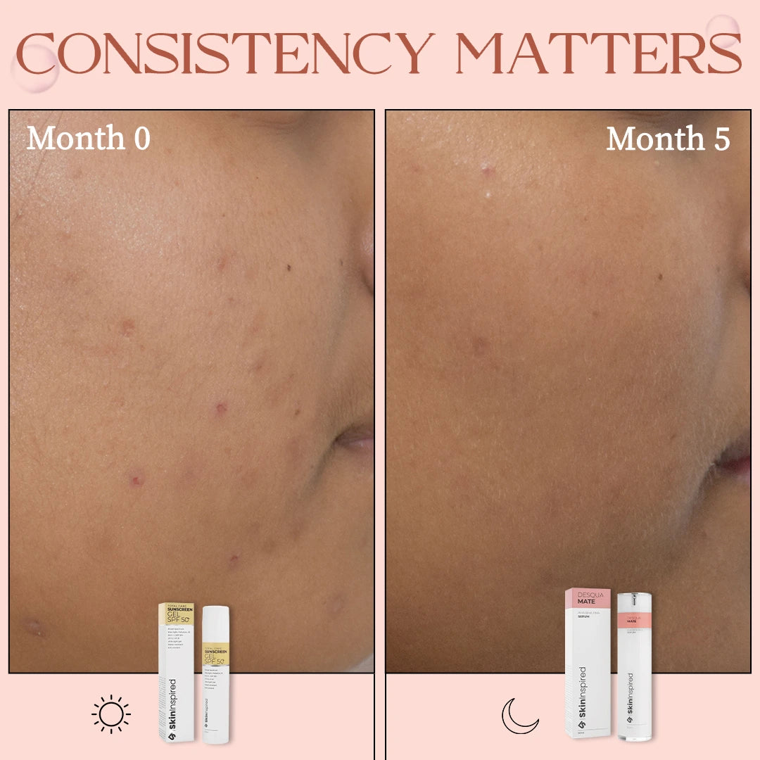 Before and after results of consistent use of SkinInspired AHA BHA PHA serum showing clearer skin and reduced acne marks