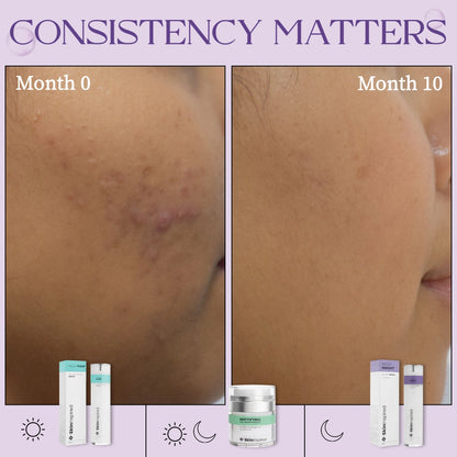 Before and after results of SkinInspired retinol serum showing improved skin texture and reduced acne marks with consistent use